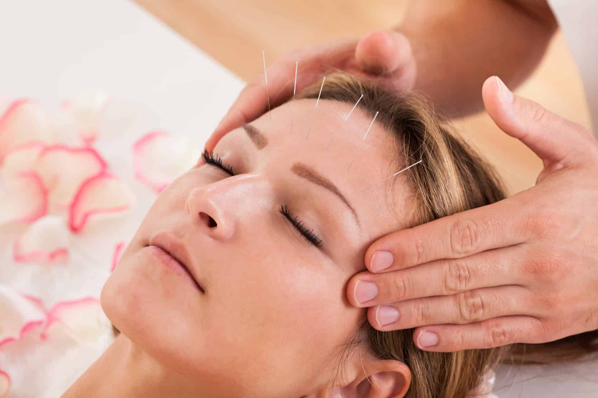 acupuncture 1