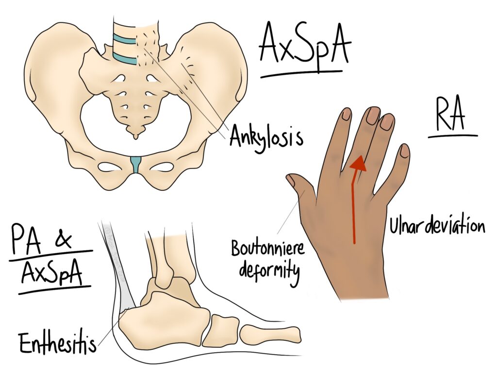 Effects of Rheumatic Diseases