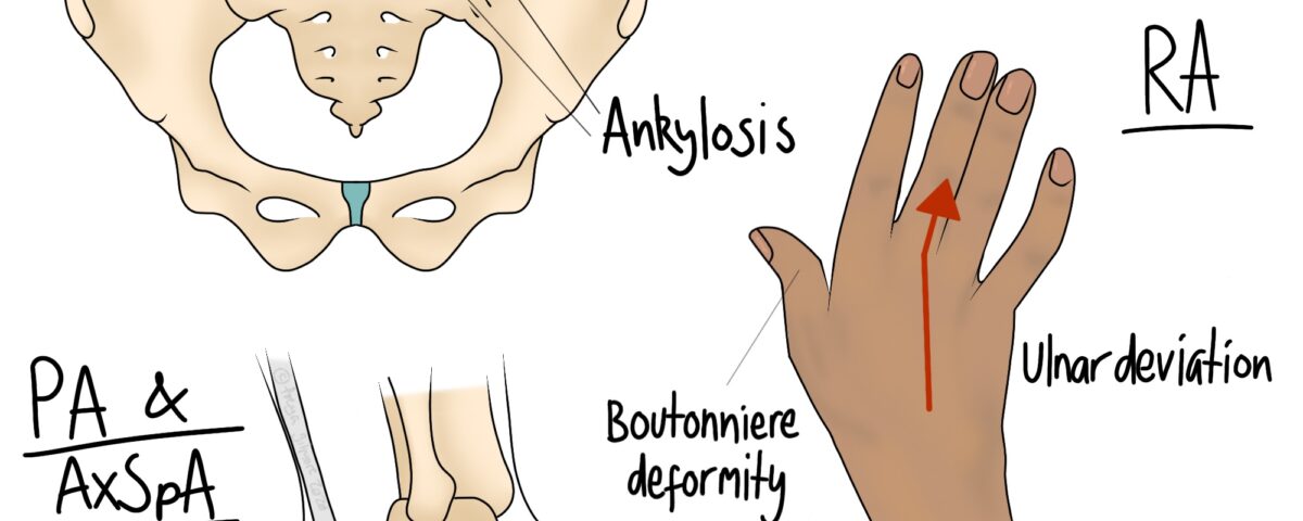 Rheumatic Pain