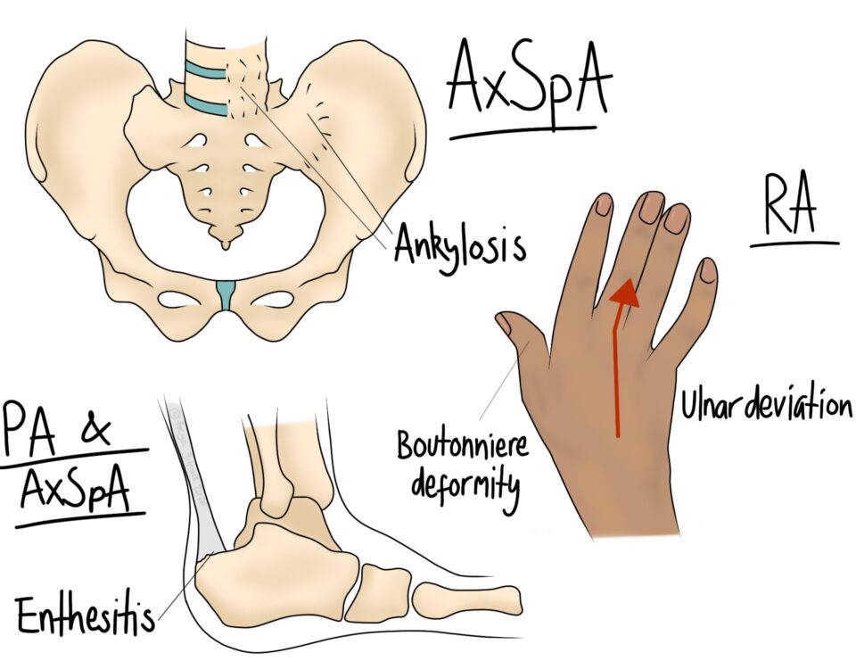 Rheumatic Pain