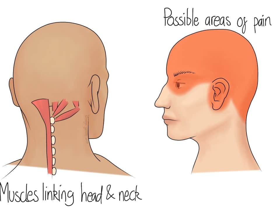 Cervicogenic Headaches