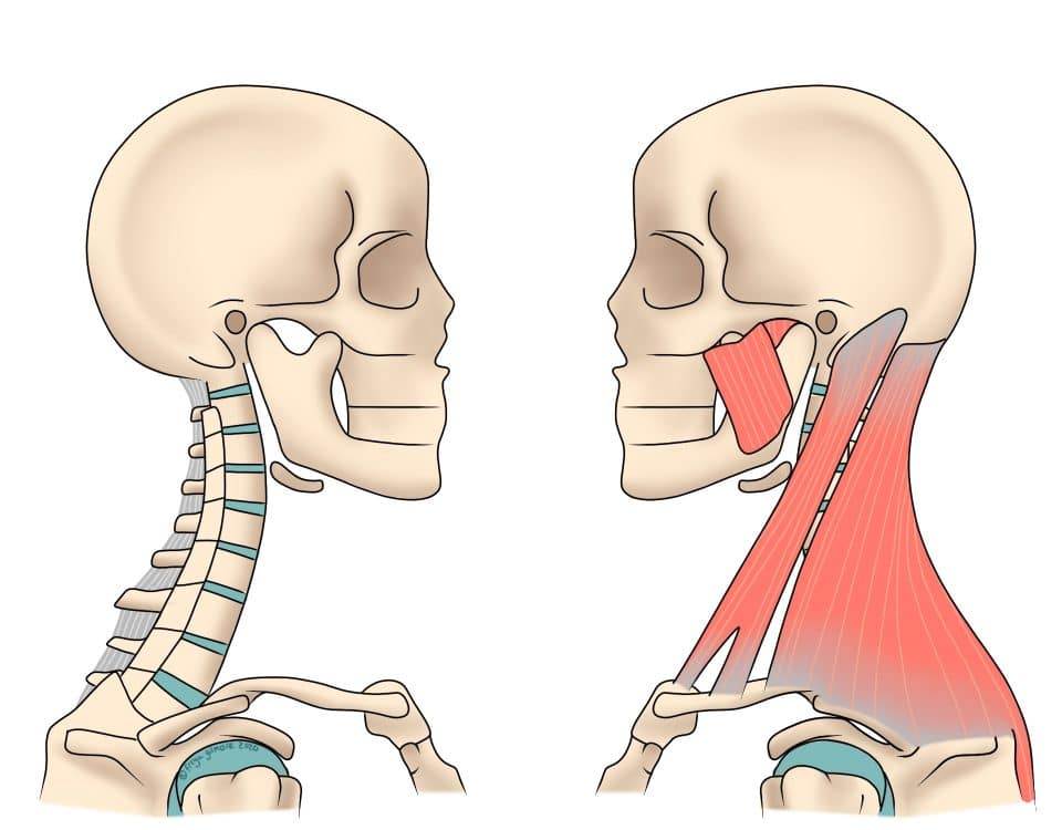 Neck Pain