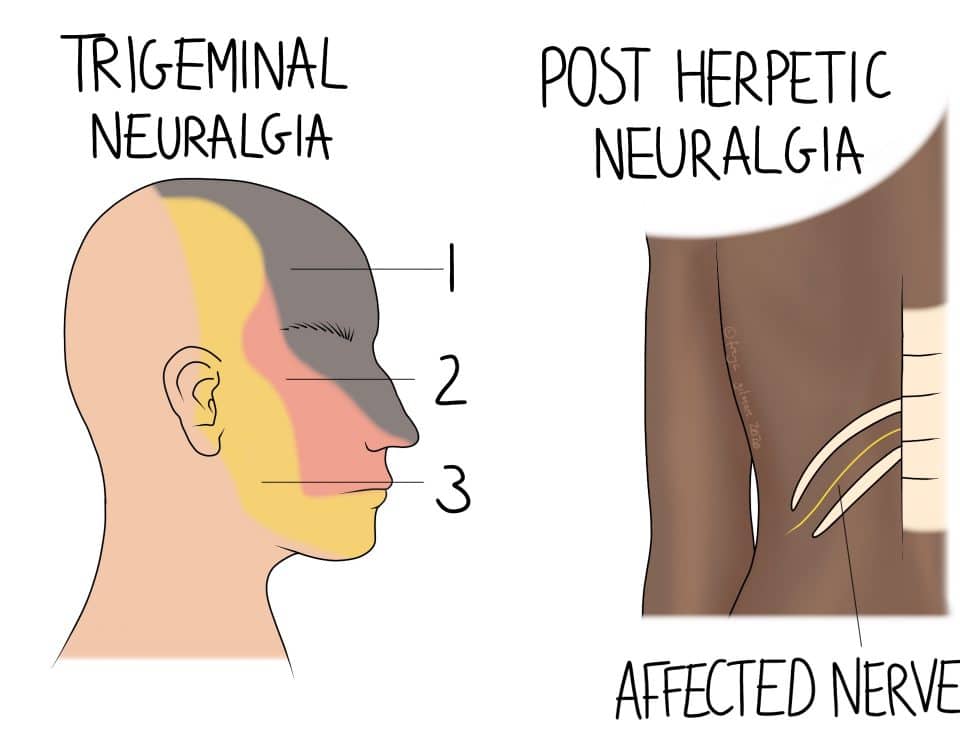 Neuralgia