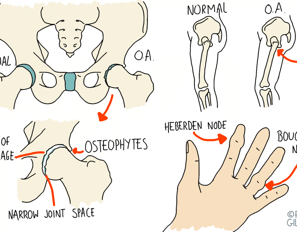 Arthritic Pain