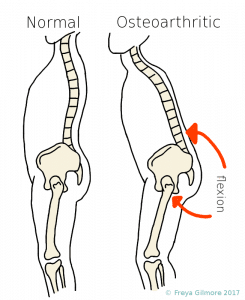 Postural changes in response to hip arthritis