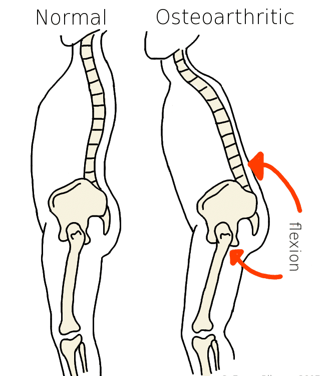 Hip & Knee Arthritis