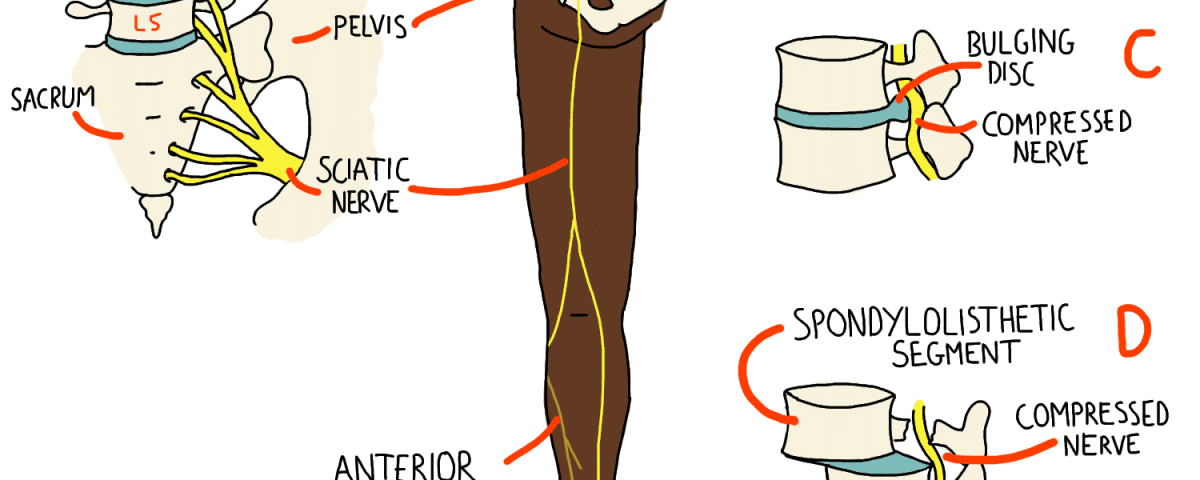 Sciatica in Pregnancy