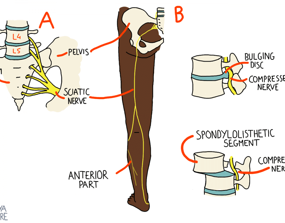 Sciatica