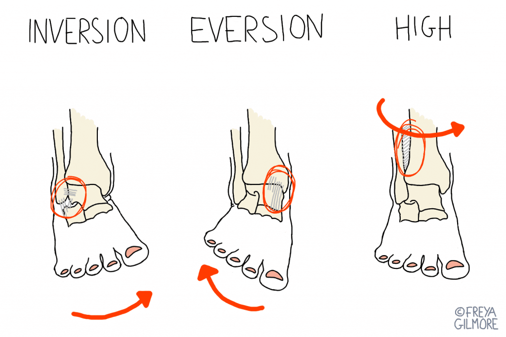 Sports Injuries: three kinds of ankle sprain