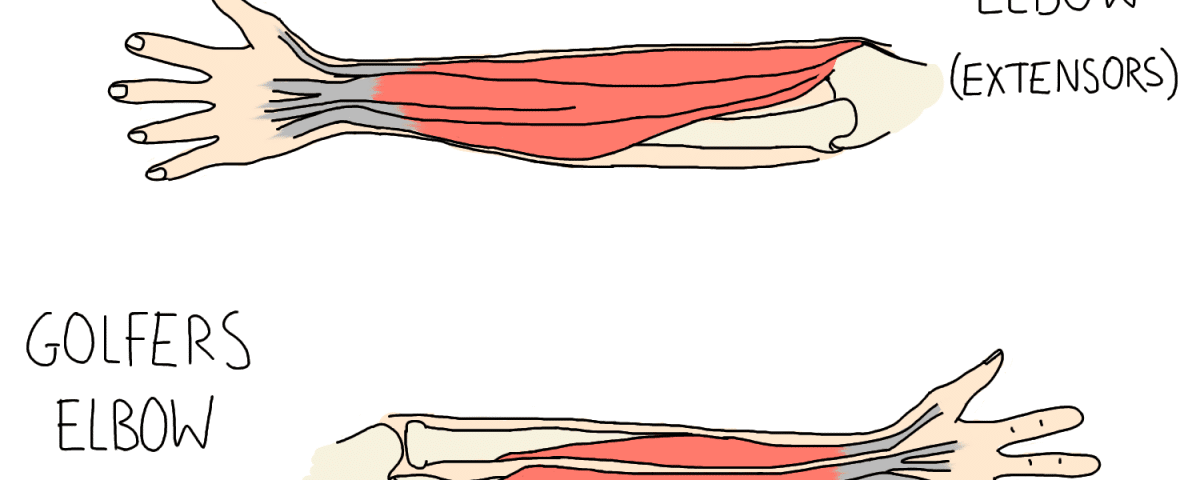 Tennis Elbow