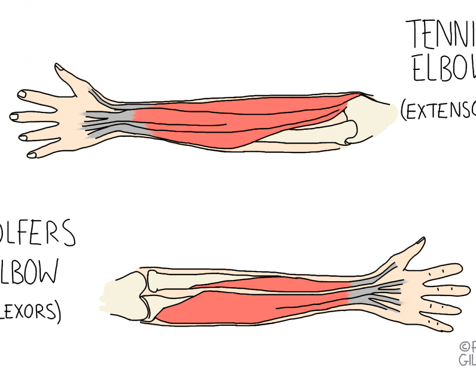 Tennis Elbow