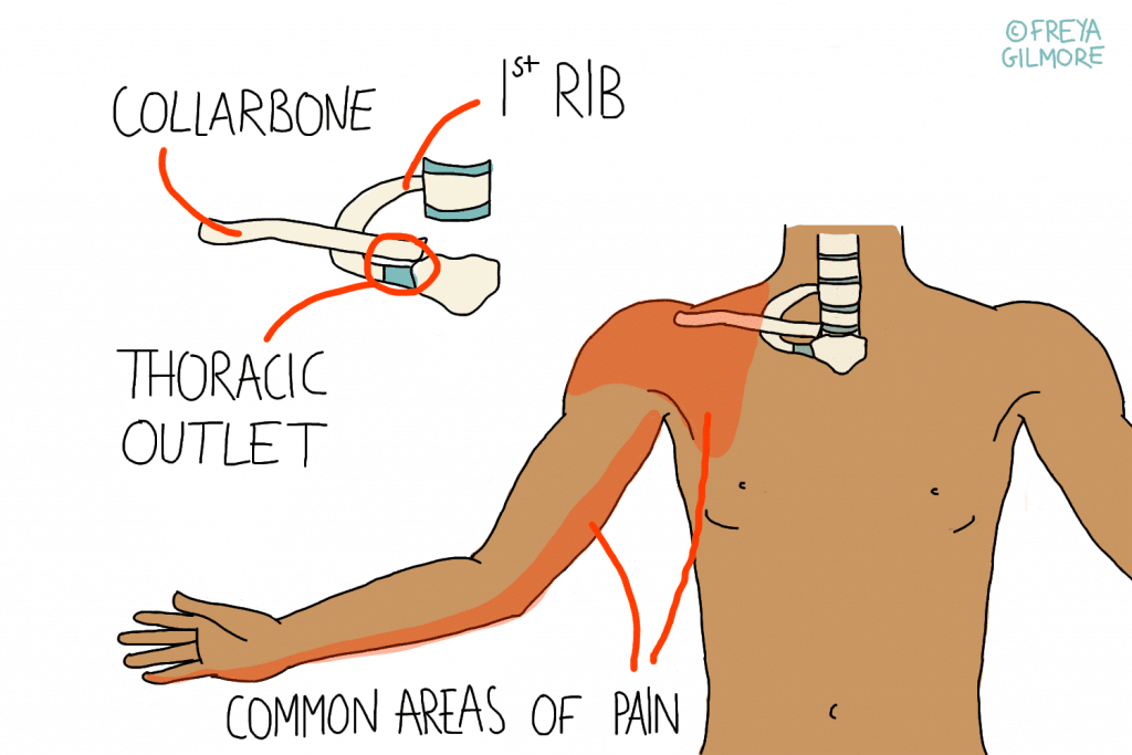 Thoracic Outlet Syndrome can affect vascular circulation