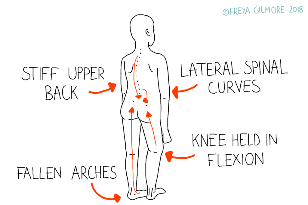 An example of how mild aches and pains can affect the rest of the body