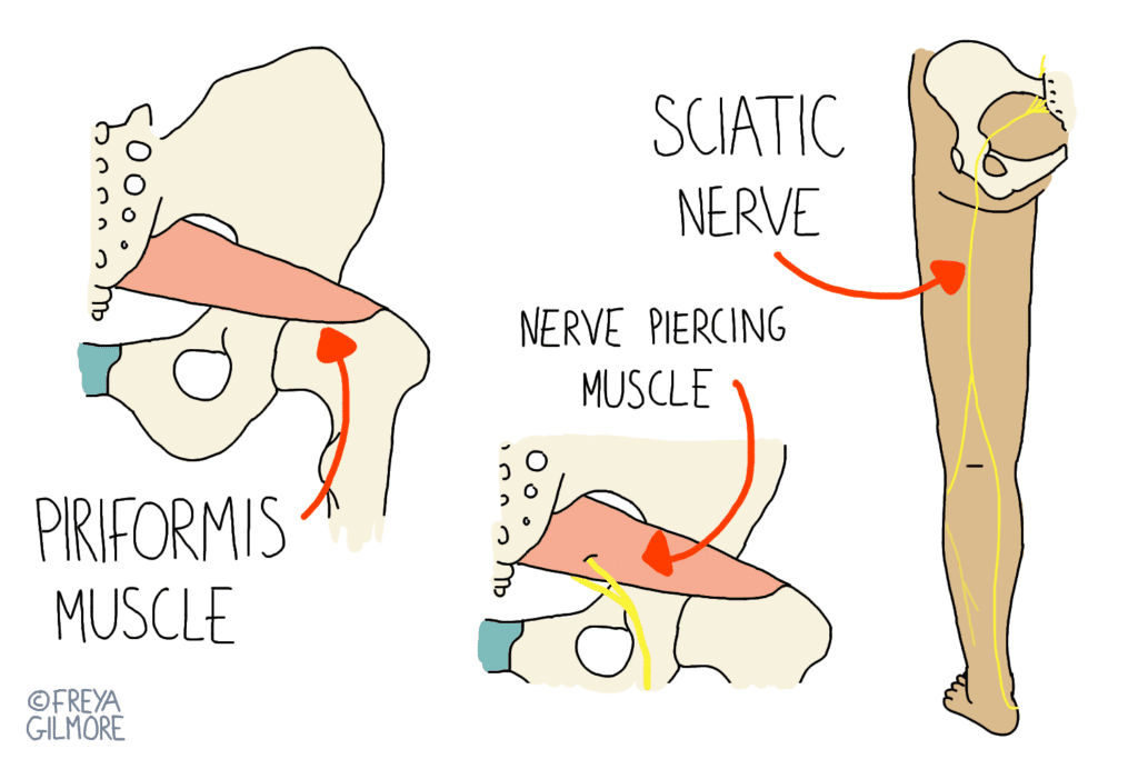 Piriformis syndrome