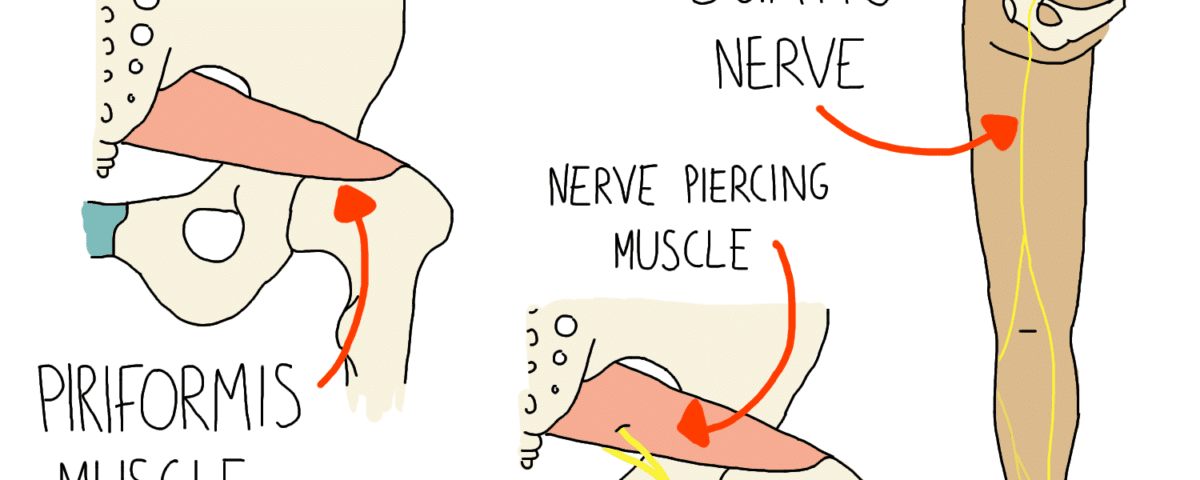 Piriformis Syndrome: Sciatica