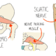 Piriformis Syndrome