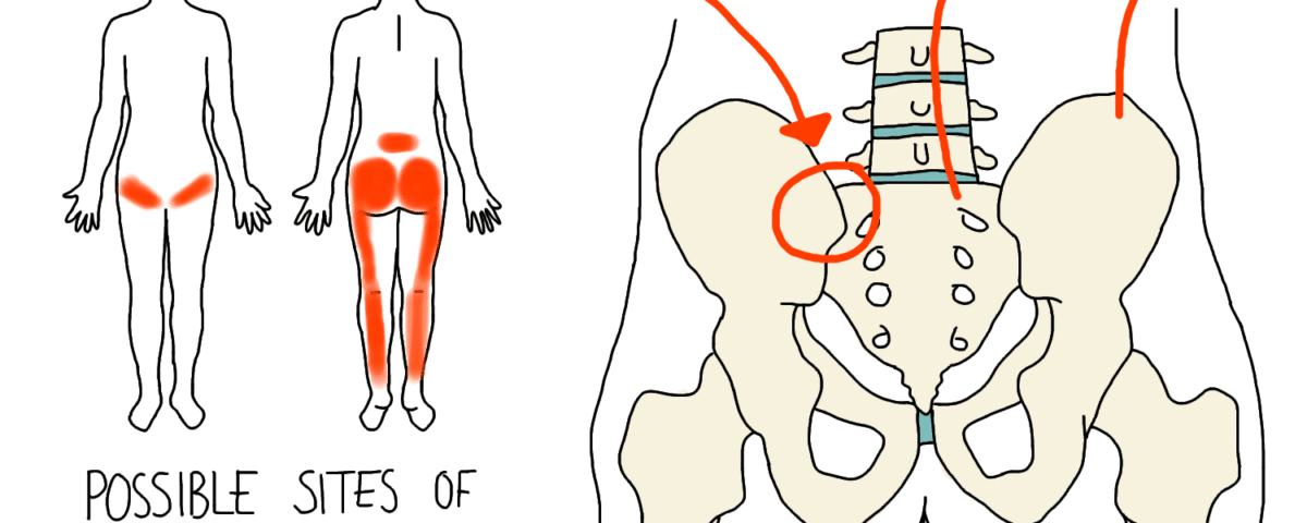 SIJ Pain and Pregnancy