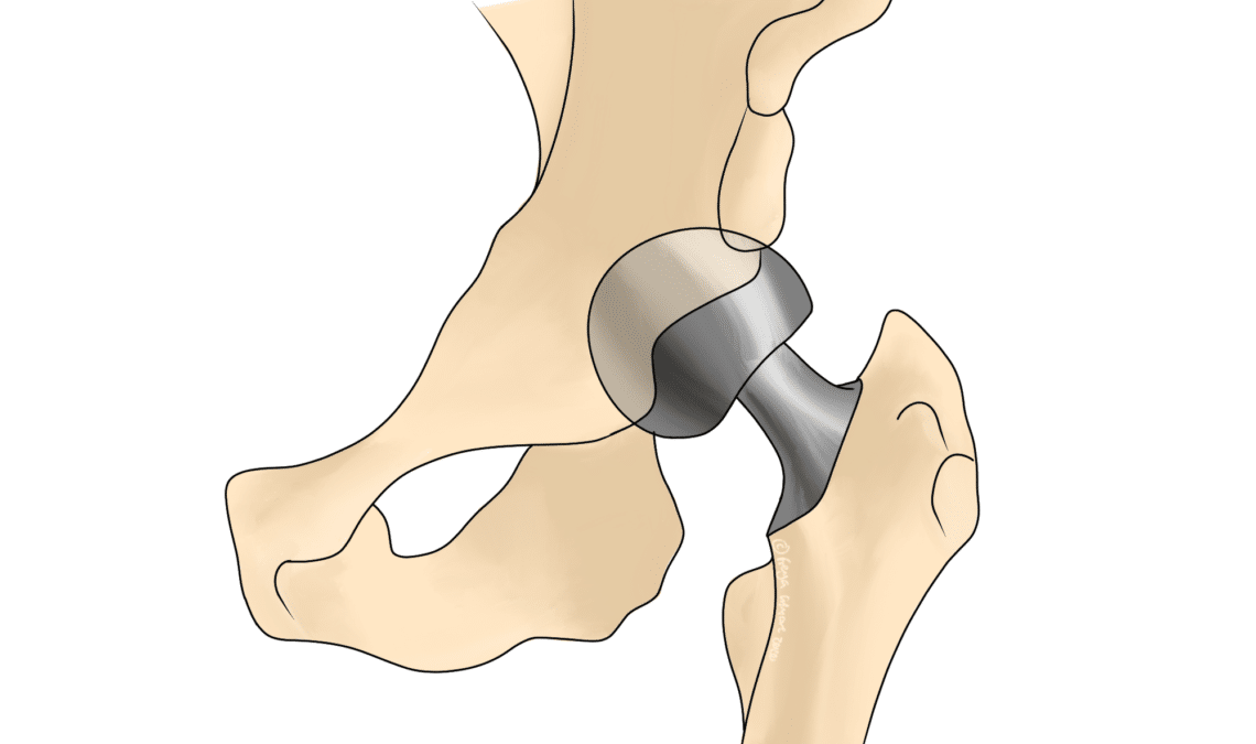 Delays to Joint Replacements