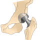 Delays to Joint Replacements