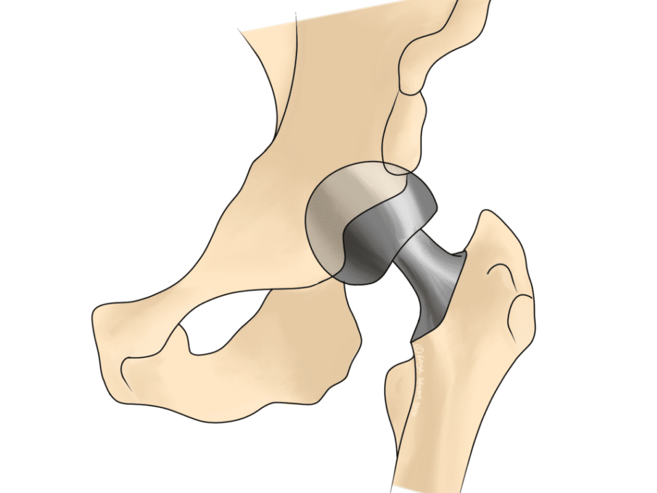 Delays to Joint Replacements