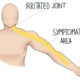 Referred Pain