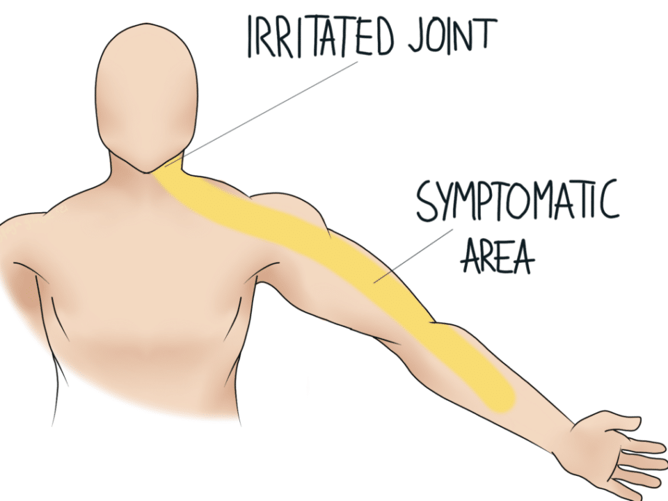 Referred Pain