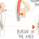Hip Bursitis
