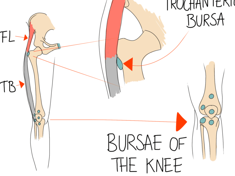 Bursitis