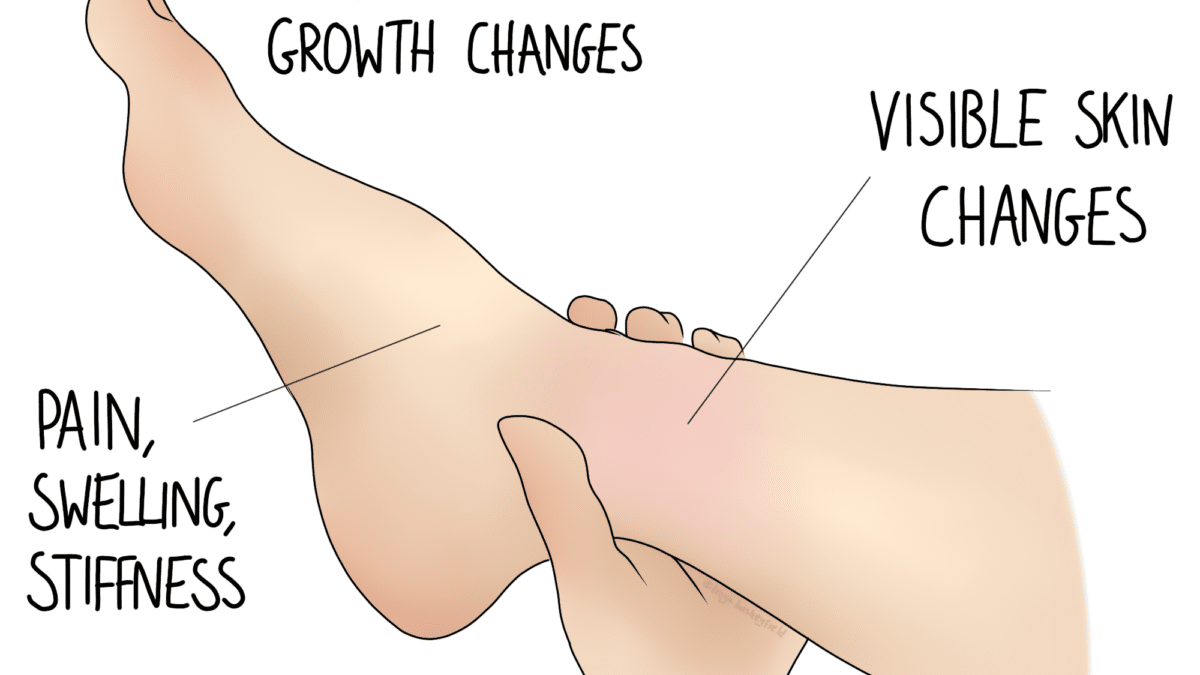 CRPS: Complex Regional Pain Syndrome