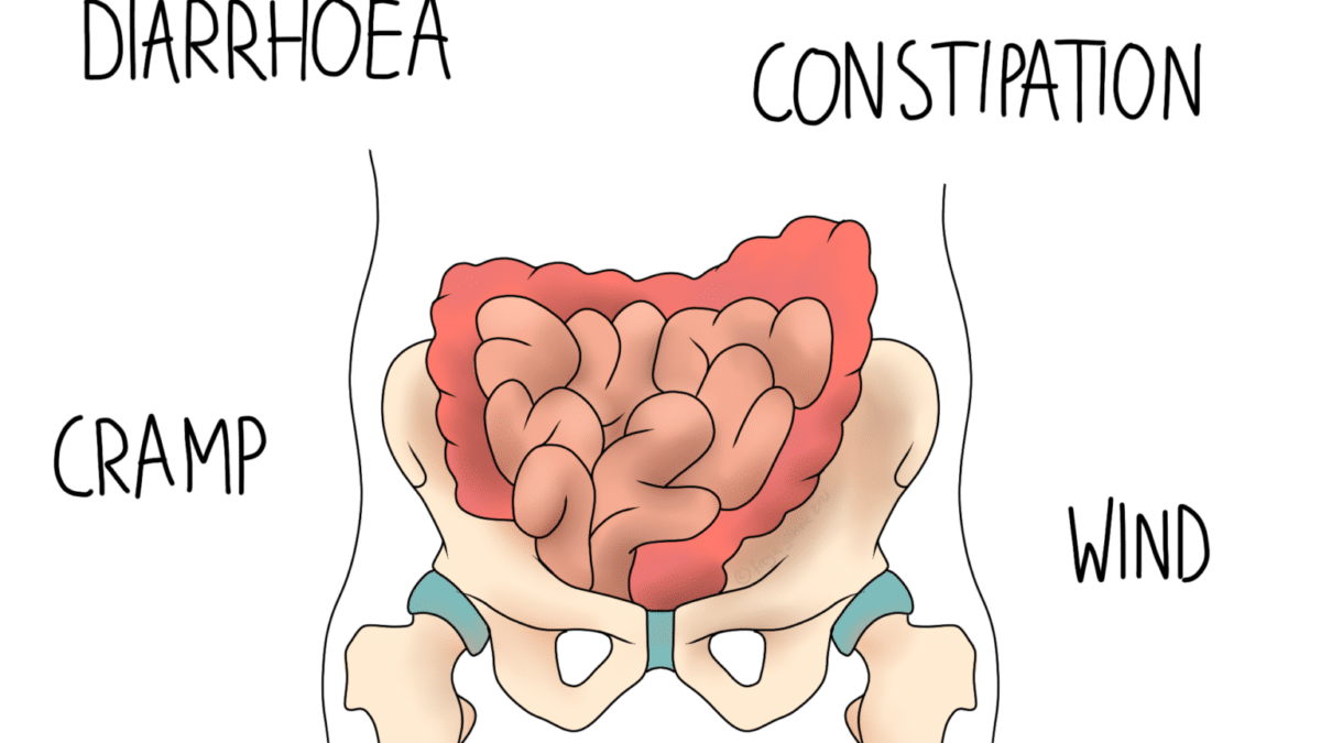 IBS: Irritable Bowel Syndrome