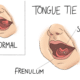 Tongue Tie