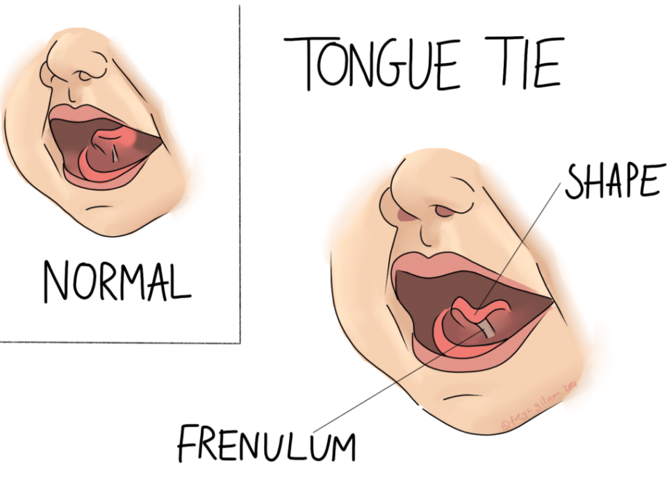 Tongue Tie