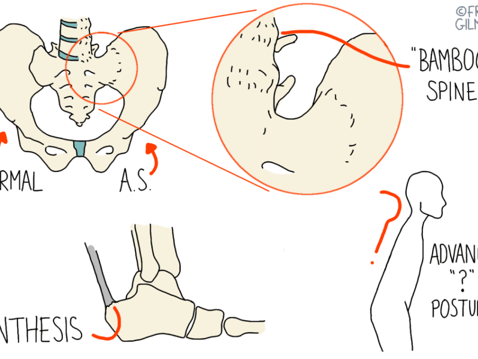 Ankylosing Spondylitis and AxSpA