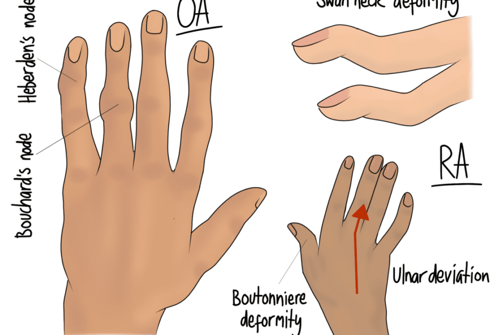 Rheumatoid arthritis and its effects on the hand