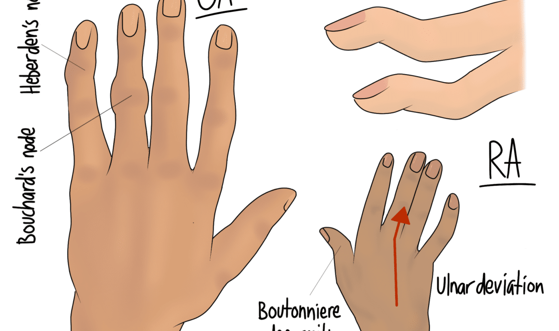 Rheumatoid Arthritis