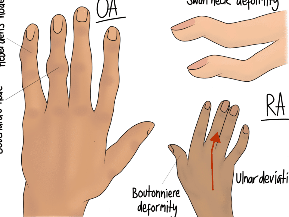 Rheumatoid Arthritis