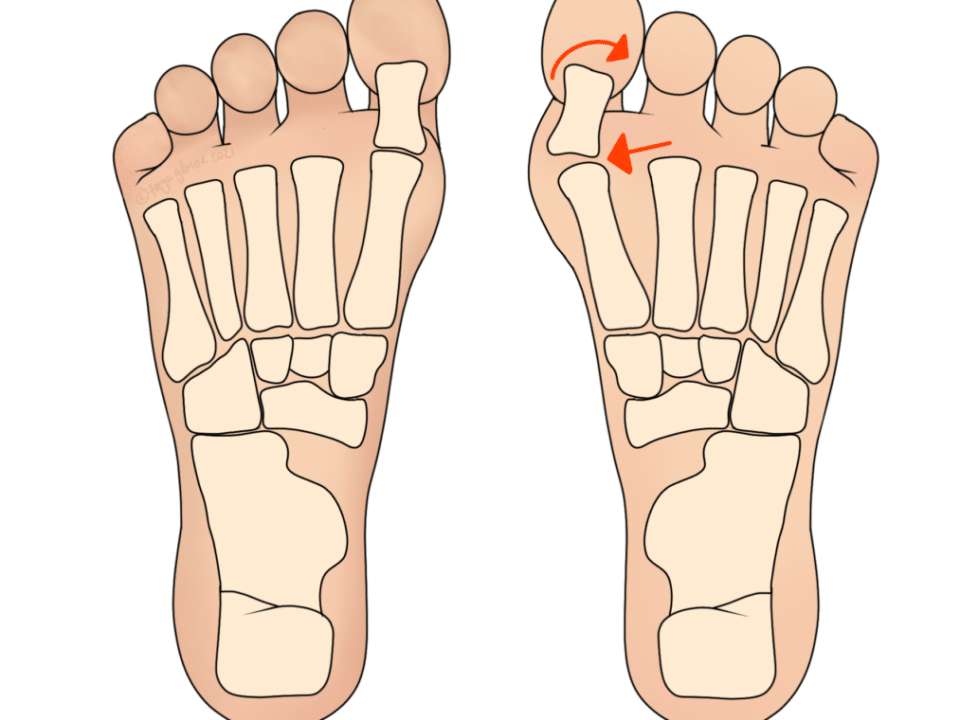 Bunions