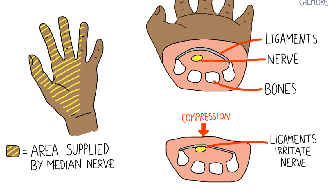 Carpal Tunnel Syndrome