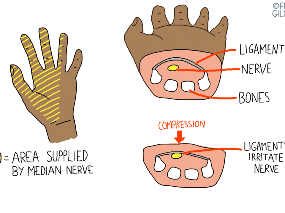 Carpal Tunnel Syndrome