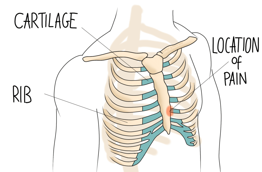 Costochondritis