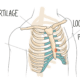 Costochondritis