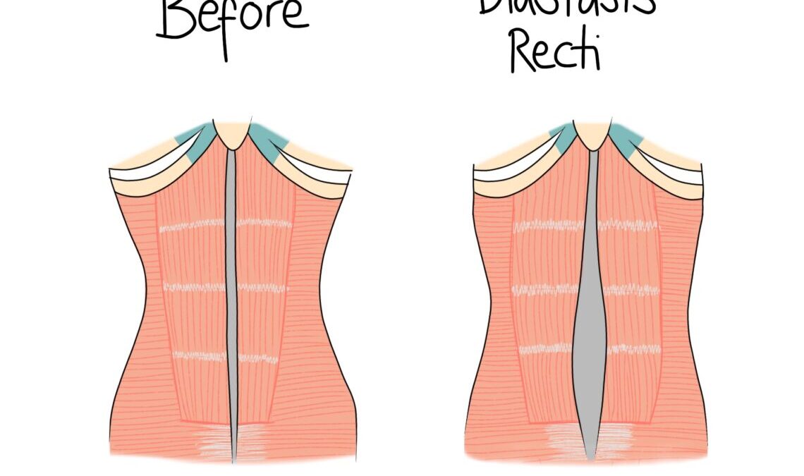 Diastasis Recti