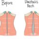 Diastasis Recti