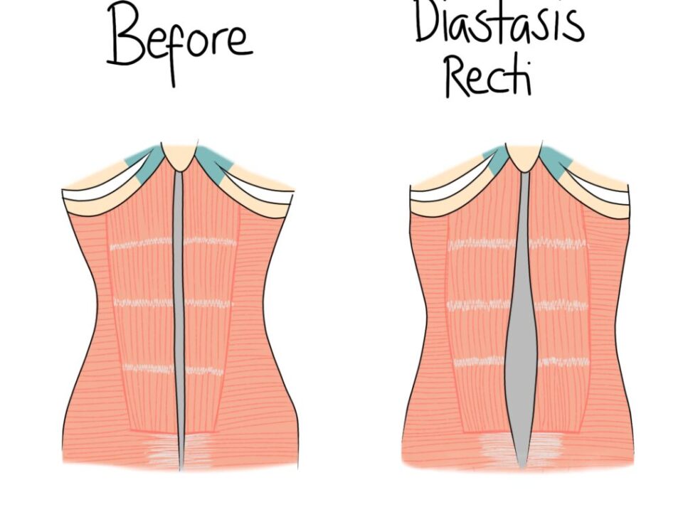 Diastasis Recti