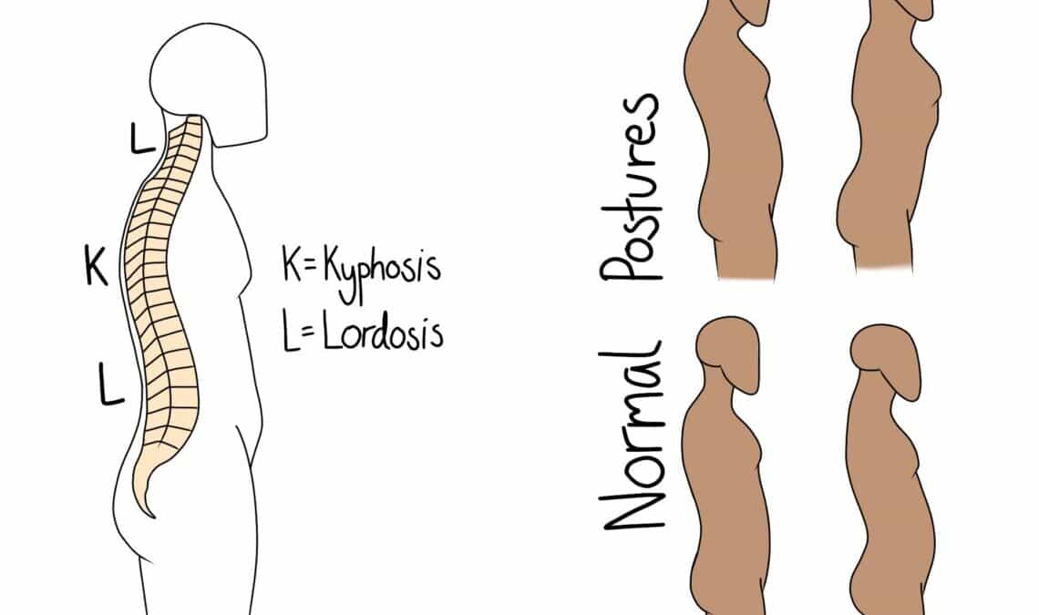Kyphosis and Lordosis