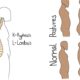 Kyphosis and Lordosis