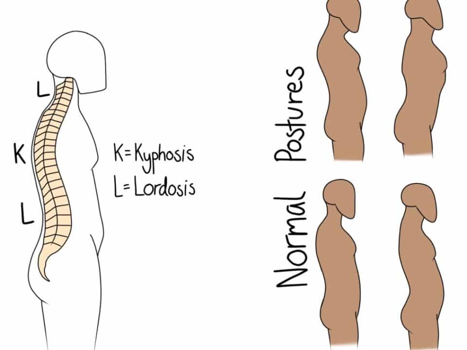 Kyphosis and Lordosis