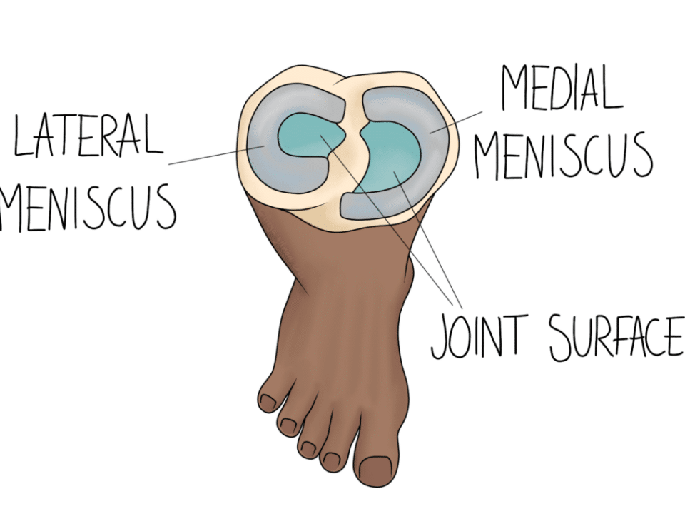 Meniscus Tears