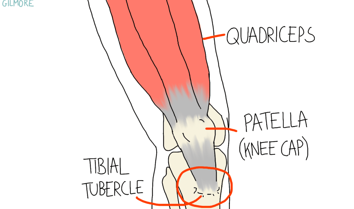 Osgood Schlatter Disease