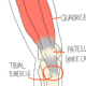 Osgood Schlatter Disease